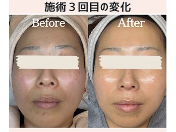 ケーブロッサムビューティーサロン(K Blossom Beauty Salon)/ダクトピールのビフォーアフター