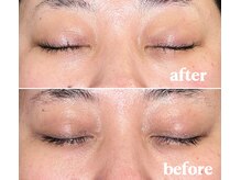 エレナ(Elena)/【before＆after】スノーピール