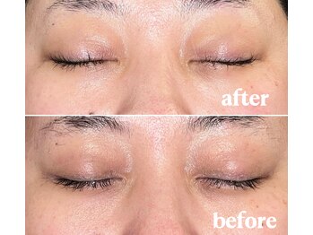 エレナ(Elena)/【before＆after】スノーピール