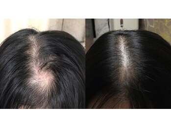 アブソリュートワン(absolute1)の写真/[都内からの来店も急増中]エクソソームでの実例多数！ほんと？と思う方こそ育毛促進！鏡を見る度凹む方に◎