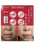 即効【二重あご撃退】☆RED SHOT+リフトアップEMS輪郭小顔70分¥19000