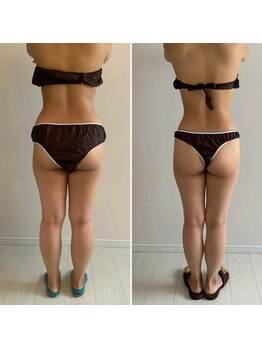 カーム整骨院/ダイエット整体ビフォーアフター