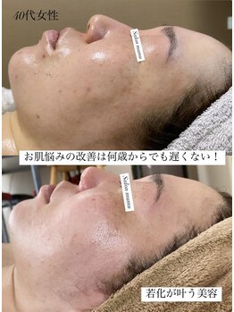 ムム(mumu)/シミ改善！シワを増やさない！