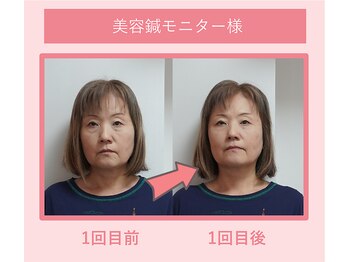 グリーンノア鍼灸院/50代女性美容鍼1回目の変化