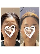 アマランス(Amarans)/人気驚きの変化ハーブピーリング