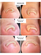 ケアプラス(care plus)/巻爪ケアジェル