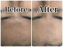 ルリアン(LeLien)/ダクトピール＋LDM 3回の効果★