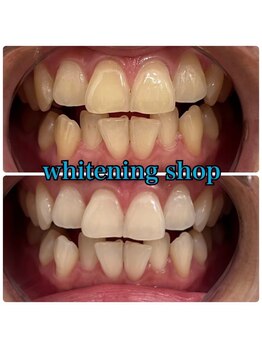 ホワイトニングショップ 武蔵小杉店/武蔵小杉ホワイトニング美白ケア