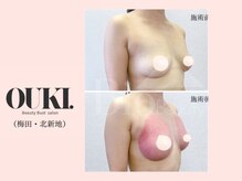 オウキ 梅田北新地(OUKI.)/バストアップ結果写真