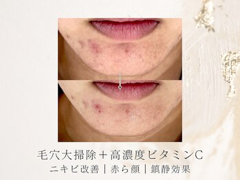 アネラボーテ(Anela Beaute)/毛穴大掃除でニキビ改善も♪