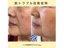 ピーナップ(P-nap)の雰囲気(気になる毛穴を綺麗に♪)