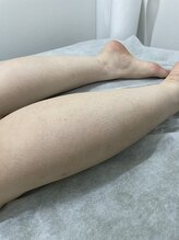 ナノハナ/鹿沼市の全身脱毛のナノハナ