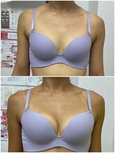 バーディー(BIRDIE)/施術3ヵ月/40代ママ/A→Cカップ