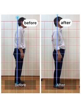 朱雀整骨院/姿勢矯正before after