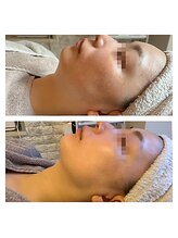 アズユウ(As U)/マーメイドセルトリートメント