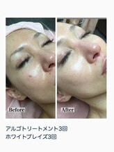 オンディーヌ 名古屋/ハーブピーリングお客様結果