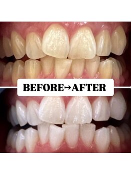 ホワイトニングサロン 豊中/Before&After美白ホワイトニング