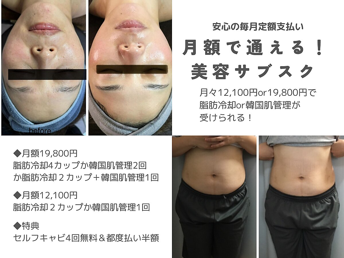 名古屋 ※他店舗あり】【5回分】新型360度脂肪冷却痩身コース