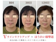 エソア(esoa)/小顔矯正×光フォト