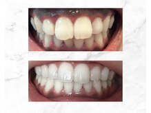 ホワイトニングビューティ 三川店/笑顔に自信を・・・