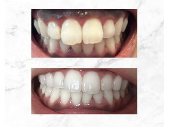 ホワイトニングビューティ 三川店/笑顔に自信を・・・