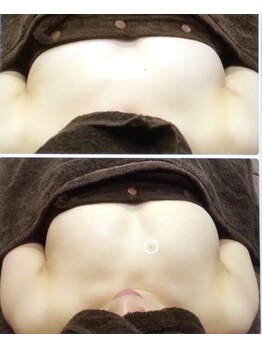 サロン アイミー(salon i me)/【バストアップ】症例