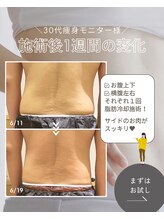 イエス マイサロン(yes My Salon)/脂肪冷却説明3