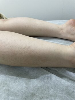 ナノハナ/鹿沼市の全身脱毛のナノハナ