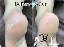 ネイルエイト 新百合ヶ丘(nail8)/お出掛け前にサックとかかとケア