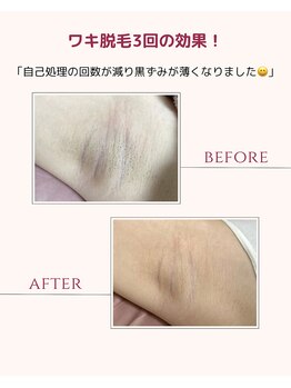 ネリネ(Nerine)/脱毛