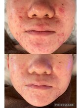 リラ(Lilas)/施術1回2週間後ビフォーアフター