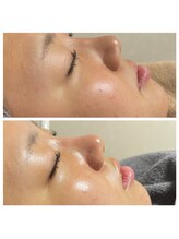 レミリー(Lemiry)/毛穴ケア陶肌ピール