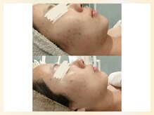 ソウナ(SONA)/厳選国産ハーブピーリング