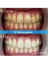 ホワイトニングカフェ 黒崎店(WhiteningCafe)/◎ホワイトニング症例写真◎