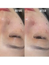 ビーマジック(Be Magic)/毛穴/脱毛/ハーブピーリング/眉