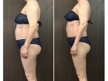 バーテックスキー(Vertexkey)/かたい脂肪はいきなり動かない