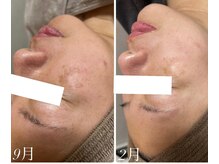 エル(Elle)/40代シミくすみシワ