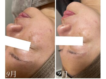 エル(Elle)/40代シミくすみシワ