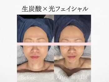 アンドミルル(and Milulu)/【小顔×たるみ改善】生炭酸+光