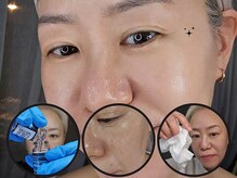 水光ピールスキン