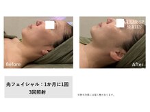 イル 名取店(iru)/光フェイシャル