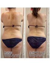 クールスパ(COOL SPA)/【40代女性】背中症例