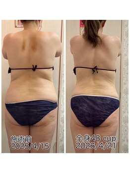 クールスパ(COOL SPA)/【40代女性】背中症例