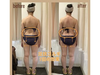 レアフィート(Rheafeet)/症例写真です。