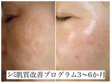 ヌー 栄(nuu)/シミ肌質改善プログラム3～6か月