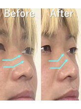 ラプリ 大宮店(Raplit)/隆鼻＋輪郭矯正40分10回