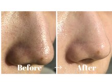 カラーリリー アンド ユン(Calla lily & yun)/新メニュー★ハイドラ毛穴洗浄