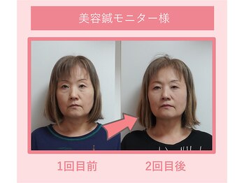 グリーンノア鍼灸院/50代女性美容鍼1-2回目の変化