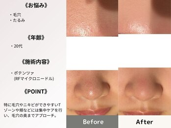 ルディラ医療提携エステ 立川店 毛穴/小顔/ニキビ・シミ・美白・シワ・たるみケア/ポテンツァ(RFマイクロニードル)