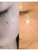 サロンドミミ(Salon de Mimi)/ダクトピール☆ヒト幹細胞導入♪